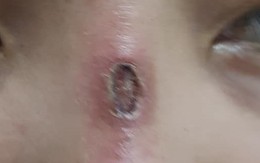 Hoại tử mũi, nát ngực vì làm đẹp đón Tết