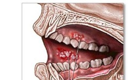 Bị ung thư vì thứ triệu người mê