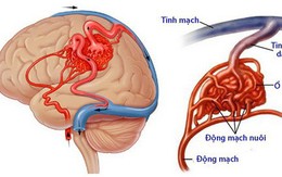 Dị dạng mạch não: Bệnh nguy hiểm, dễ nhầm lẫn