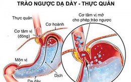 Phương thức hay chữa trào ngược dạ dày - thực quản