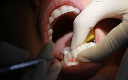 Bác sĩ mách bạn cách để không bị mất răng vì viêm nha chu