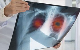 2 vợ chồng cùng mắc bệnh ung thư phổi: Lời cảnh tỉnh tới những người chồng đang bào mòn sức khỏe của người thân vì thói quen độc hại