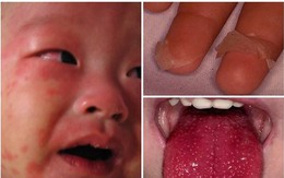 Trẻ em sốt nhiều ngày liên tục kèm mắt đỏ, coi chừng mắc bệnh hiếm này