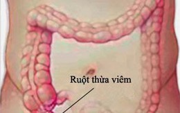 Dấu hiệu viêm ruột thừa?