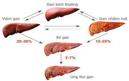 Bài thuốc chữa bệnh gan do rượu