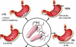 Nhiễm vi khuẩn HP có đáng lo?