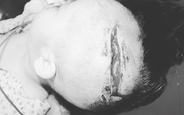Hà Nội: Cháu bé 2 tuổi trẻ bị chó tấn công lộ xương sọ