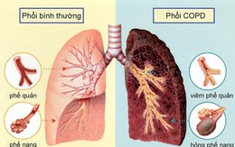 Mắc căn bệnh này chẳng khác nào ung thư phổi