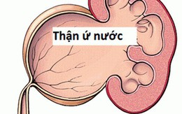 Bài thuốc trị thận ứ nước