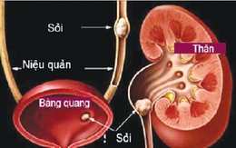 Bài thuốc điều trị sỏi tiết niệu