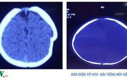 Ngã xe tập đi, bé 8 tháng tuổi ở Phú Thọ bị lún sọ não