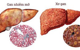 Thói quen xấu nhiều người đang bức tử lá gan của mình