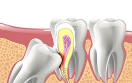 Răng khôn: Có nên nhổ hay không?