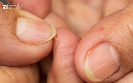 Móng tay vàng là dấu hiệu cảnh báo những vấn đề sức khỏe nghiêm trọng này