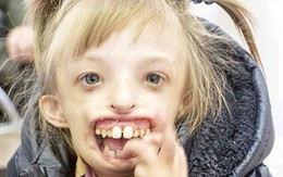 Bé gái khuyết nửa khuôn mặt lần đầu tiên có thể cười