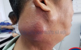 Đắp thuốc nam chữa ung thư họng, khối u phát triển "tăng tốc" gây lệch mặt, khó thở