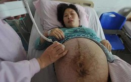 Sản phụ mang thai 3 tháng mà bụng "to như cái trống", đến ngày lâm bồn bệnh viện phải huy động toàn bộ bác sĩ giỏi đỡ đẻ