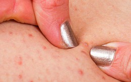 Lưng mọc nhiều mụn có thể là biểu hiện của 4 vấn đề sức khỏe sau