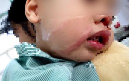 Nhỏ nhầm axit vào mũi khiến con trai bỏng nặng