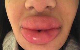 Mất gần 9 triệu bơm môi, 21 triệu để sửa lại nhưng nữ nha sĩ này cuối cùng vẫn chỉ nhận được đôi môi “thảm họa”