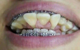 Sởn gai ốc trước những tai nạn niềng răng đáng sợ: Hóa ra phương pháp làm đẹp “thần thánh” này không hề an toàn như bạn nghĩ!