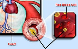 Mỡ máu cao có thể gây tổn thương nội tạng và mạch máu