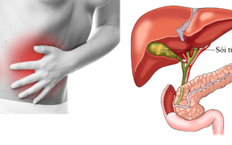 Mất mật vì sỏi: Bà mẹ trẻ 27 tuổi sốc nặng vì thói quen này