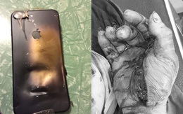 Thanh niên bị dập nát bàn tay vì điện thoại phát nổ