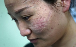 Dị ứng da, vết máu hằn trên mũi: Đằng sau sự hi sinh thầm lặng của y bác sĩ TQ trên tuyến đầu chống dịch