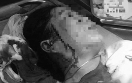 Bình Thuận: Hẹn đánh ghen, một phụ nữ bị đâm rách mặt