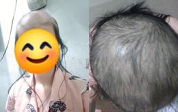 Cô gái hễ bị stress là nhổ tóc, nhìn tình cảnh bây giờ, ai cũng phải sợ hãi khuyên can hết lời