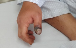 Liên tục ca bị rắn độc cắn vào mùa hè: GĐ Trung tâm Chống độc Bệnh viện Bạch Mai chỉ lý do