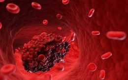 ICU Vũ Hán: 60% bệnh nhân Covid-19 bị đen ngón chân tay, thậm chí hoại tử