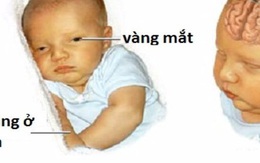 Bé 3 tuổi bại não từ di chứng vàng da sơ sinh: Ranh giới mong manh nhận biết vàng da bệnh lý