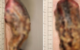 Phớt lờ miếng da nhỏ sần sùi trên lưng, 3 năm sau người đàn ông tá hỏa khi nó biến thành một cái ‘sừng’ 14cm bị ung thư
