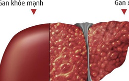 Xơ gan do rượu – cửa tử của nhiều người