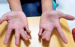 Dị tật bàn tay 'càng tôm hùm', bé 5 tuổi được bác sĩ tái tạo lành lặn