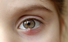 8 dấu hiệu cảnh báo bệnh tật được “khắc” rất rõ trên mắt: Ai cũng cần đọc để đối chiếu với sức khỏe bản thân