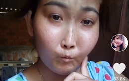 Cô gái Bến Tre mắc bệnh xơ cứng bì quay clip tiktok hút 2 triệu view: Gia cảnh khó khăn, bị trêu chọc vì gương mặt kì lạ
