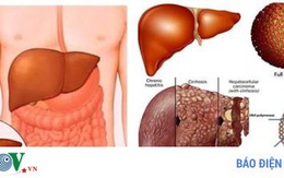 Người bệnh nhiễm trùng gan nên ăn những thực phẩm này