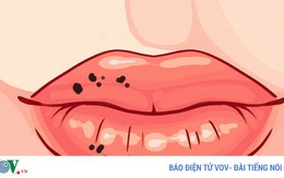 8 dấu hiệu trên môi cảnh báo sức khỏe có vấn đề