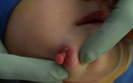Vừa mới chào đời, bé gái đã khiến các bác sĩ kinh ngạc khi có đến 2 cái miệng trên mặt  - bệnh lý vô cùng hiếm gặp