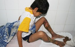 Vụ "cha dùng xăng đốt chân con": "Làm vậy để dạy dỗ con…"