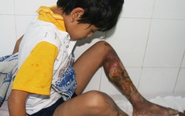 Cha dùng xăng thiêu chân con trai