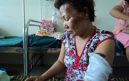 Chồng đổ xăng đốt vợ để “dạy dỗ” vợ