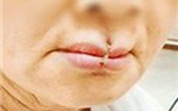 Mẹ chồng tự khâu miệng sau khi cãi nhau với con dâu