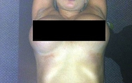 Trộm tiền ngân hàng để đi nâng ngực