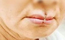 Mẹ chồng tự khâu miệng sau khi cãi nhau với con dâu