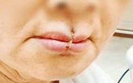 Cãi nhau với con dâu người Việt, mẹ chồng tự khâu môi