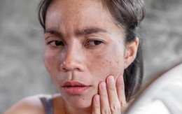 Collagen tự thân nhân bản - Lời giải cho những đắn đo của chị em khi làm đẹp